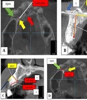 Anatomical Variations of the Canalis Sinuosus in the Anterior Maxilla: A Cone-Beam Computed Tomography Study