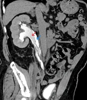 Ureteral Intraluminal Dissection Caused by Spontaneous Ureteropelvic Rupture: A Rare Case Report and Review of the Literature