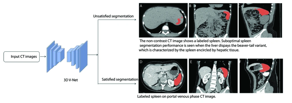 3D V-Net–based automatic spleen segmentation workflow and representative satisfactory/unsatisfactory examples. 3D V-Net–based automatic spleen segmentation workflow and representative satisfactory/unsatisfactory examples.
