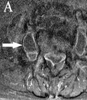 When a Psoas Abscess Is No Longer an Abscess: Computed Tomography Angiography in Detection of Type I Endoleak with Aorto-Psoas Fistula After Endovascular Aortic Repair