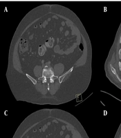 Quantitative Assessment of Bone Lesions in Prostate Cancer: Diagnostic Performance of CT Hounsfield Units in Differentiating Metastases From Benign Enostoses