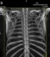 Quantitative Assessment of DECT Perfusion Parameters in Acute Pulmonary Embolism: Association with CT-Based Severity Indices