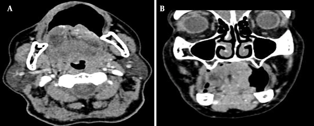 The puffed-cheek technique was used in this patient with left lateral tongue squamous cell carcinoma to separate the buccal mucosa and improve visualization of the tumor surface, as shown in the axial (A) and coronal (B) planes of contrast-enhanced CT. The puffed-cheek technique was used in this patient with left lateral tongue squamous cell carcinoma to separate the buccal mucosa and improve visualization of the tumor surface, as shown in the axial (A) and coronal (B) planes of contrast-enhanced CT.