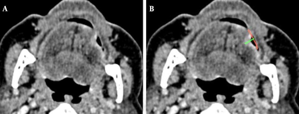 Measurement of depth of invasion on the axial planes of contrast-enhanced computed tomography (A and B) in a 62-year-old man with oral tongue squamous cell carcinoma and an ulcerative tumor at the left lateral border of the tongue. The red virtual arc represents the reconstructed mucosal line joining the normal mucosal surface on the adjacent sides of the lesion. The green line shows tumor depth, measured perpendicularly from the deepest point to the reconstructed mucosal line without considering the ulcer surface. Measurement of depth of invasion on the axial planes of contrast-enhanced computed tomography (A and B) in a 62-year-old man with oral tongue squamous cell carcinoma and an ulcerative tumor at the left lateral border of the tongue. The red virtual arc represents the reconstructed mucosal line joining the normal mucosal surface on the adjacent sides of the lesion. The green line shows tumor depth, measured perpendicularly from the deepest point to the reconstructed mucosal line without considering the ulcer surface.