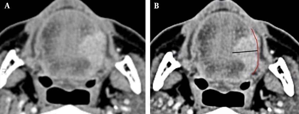 Measurement of depth of invasion on the axial planes of contrast-enhanced computed tomography (A and B) in a 58-year-old man with oral tongue squamous cell carcinoma and a small exophytic component at the left lateral border of the tongue. The red line represents the reconstructed mucosal line joining the normal mucosal surface on the adjacent sides of the lesion. The black line shows tumor depth, measured perpendicularly from the deepest point to the reconstructed mucosal line, excluding the exophytic component. Measurement of depth of invasion on the axial planes of contrast-enhanced computed tomography (A and B) in a 58-year-old man with oral tongue squamous cell carcinoma and a small exophytic component at the left lateral border of the tongue. The red line represents the reconstructed mucosal line joining the normal mucosal surface on the adjacent sides of the lesion. The black line shows tumor depth, measured perpendicularly from the deepest point to the reconstructed mucosal line, excluding the exophytic component.