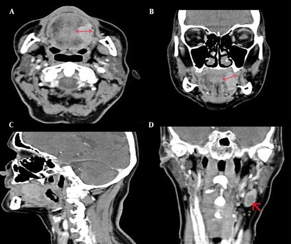 Contrast-enhanced computed tomography of a 60-year-old man with lateral tongue squamous cell carcinoma. Red lines indicate rDOI measurement in the axial (A) and coronal (B) planes: a perpendicular line from the proposed normal mucosal baseline to the deepest point of tumor invasion. In this case, the measurement was approximately 17 mm in both coronal and axial planes; however, the plane showing the greatest DOI is preferred for measurement. The sagittal plane (C) is not representative of maximum DOI in laterally located tongue squamous cell carcinoma. pDOI = 16 mm; rDOI by Radiologist 1 = 17 mm; rDOI by Radiologist 2 = 17.5 mm. The red arrow in the coronal plane (D) shows necrotic lymphadenopathy at level II of the left cervical chain in the same patient. Contrast-enhanced computed tomography of a 60-year-old man with lateral tongue squamous cell carcinoma. Red lines indicate rDOI measurement in the axial (A) and coronal (B) planes: a perpendicular line from the proposed normal mucosal baseline to the deepest point of tumor invasion. In this case, the measurement was approximately 17 mm in both coronal and axial planes; however, the plane showing the greatest DOI is preferred for measurement. The sagittal plane (C) is not representative of maximum DOI in laterally located tongue squamous cell carcinoma. pDOI = 16 mm; rDOI by Radiologist 1 = 17 mm; rDOI by Radiologist 2 = 17.5 mm. The red arrow in the coronal plane (D) shows necrotic lymphadenopathy at level II of the left cervical chain in the same patient.