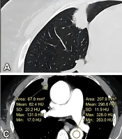 Preoperative CT Morphology and Tumor Extracellular Volume Fraction for Identifying Air-Space Spread in 1 - 3 cm Solid Lung Adenocarcinoma