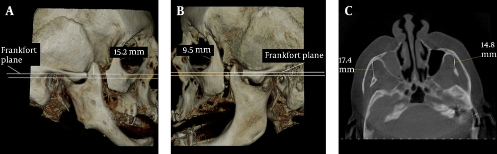 Case 2; A, 3D view of the elongated right coronoid process; B, 3D view of the elongated left coronoid process; C, The distance between the coronoid process and the inner face of the frontal part of the zygomatic bone on axial CBCT scan Case 2; A, 3D view of the elongated right coronoid process; B, 3D view of the elongated left coronoid process; C, The distance between the coronoid process and the inner face of the frontal part of the zygomatic bone on axial CBCT scan