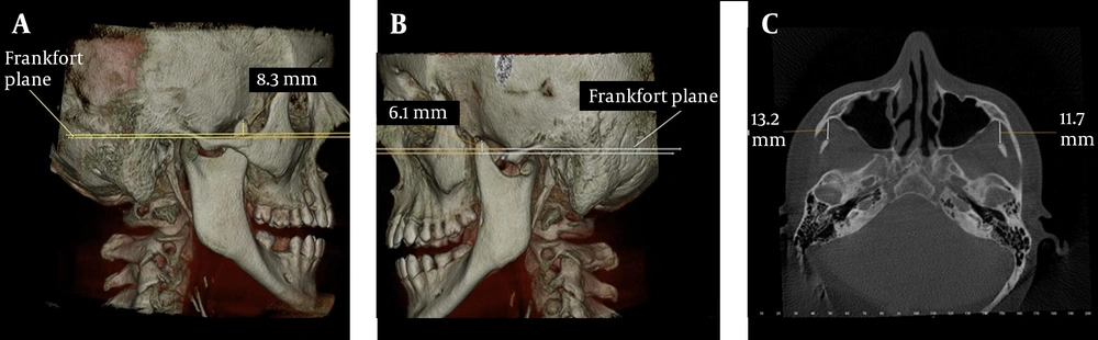 Case 3; A, 3D view of the elongated right coronoid process; B, 3D view of the elongated left coronoid process; C, The distance between the coronoid process and the inner face of the frontal part of the zygomatic bone on axial CBCT scan Case 3; A, 3D view of the elongated right coronoid process; B, 3D view of the elongated left coronoid process; C, The distance between the coronoid process and the inner face of the frontal part of the zygomatic bone on axial CBCT scan