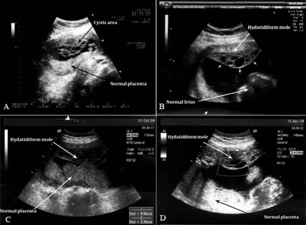 Ultrasonography in a 39-year-old woman with twin pregnancy with a complete hydatidiform mole and a coexisting viable fetus; A, US shows a cystic area at the anterior side of the uterus and normal placenta at 15 weeks of pregnancy; B, Ultrasonography shows a normal fetus with hydatidiform mole at 18 weeks gestation; C, Ultrasonography shows a normal placenta and fetus with hydatidiform mole at 24 weeks gestation; D, Ultrasonography shows placenta and fetus with hydatidiform mole at 28 weeks gestation. Successive prenatal examination manifested the patient in good condition without any serious problems for the mother and the fetus. Ultrasonography in a 39-year-old woman with twin pregnancy with a complete hydatidiform mole and a coexisting viable fetus; A, US shows a cystic area at the anterior side of the uterus and normal placenta at 15 weeks of pregnancy; B, Ultrasonography shows a normal fetus with hydatidiform mole at 18 weeks gestation; C, Ultrasonography shows a normal placenta and fetus with hydatidiform mole at 24 weeks gestation; D, Ultrasonography shows placenta and fetus with hydatidiform mole at 28 weeks gestation. Successive prenatal examination manifested the patient in good condition without any serious problems for the mother and the fetus.