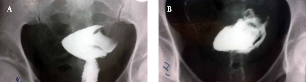 A and B, HSG illustrates a large endometrial cavity with a filling defect A and B, HSG illustrates a large endometrial cavity with a filling defect
