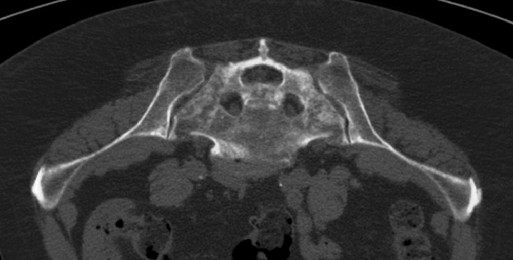 Thin-sliced preinterventional CT (prone position and mirrored afterwards) Extensive fractured bone mass between the sacral foramina and the iliosacral joint