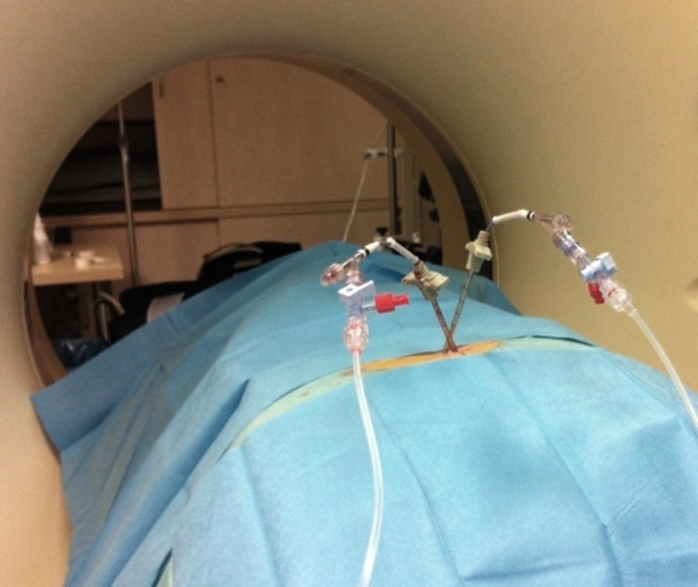 Patient positioning in the gantry with the inserted hollow needles and the connected balloon catheter system Patient positioning in the gantry with the inserted hollow needles and the connected balloon catheter system
