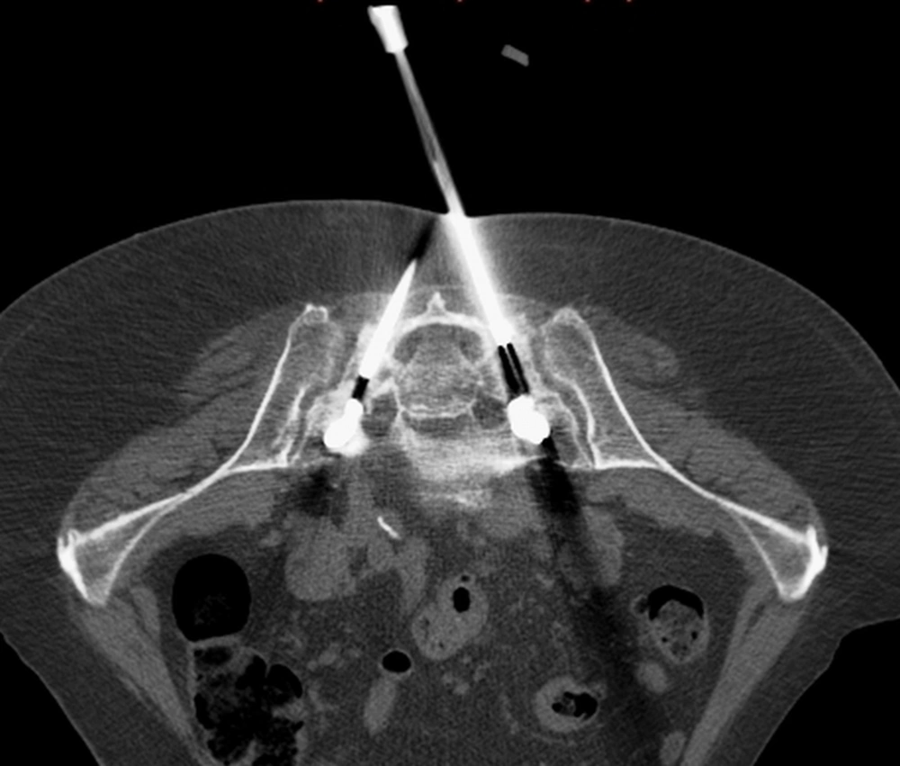 Single-slice CT image during balloon dilatation in the fractures zones of the os sacrum Single-slice CT image during balloon dilatation in the fractures zones of the os sacrum