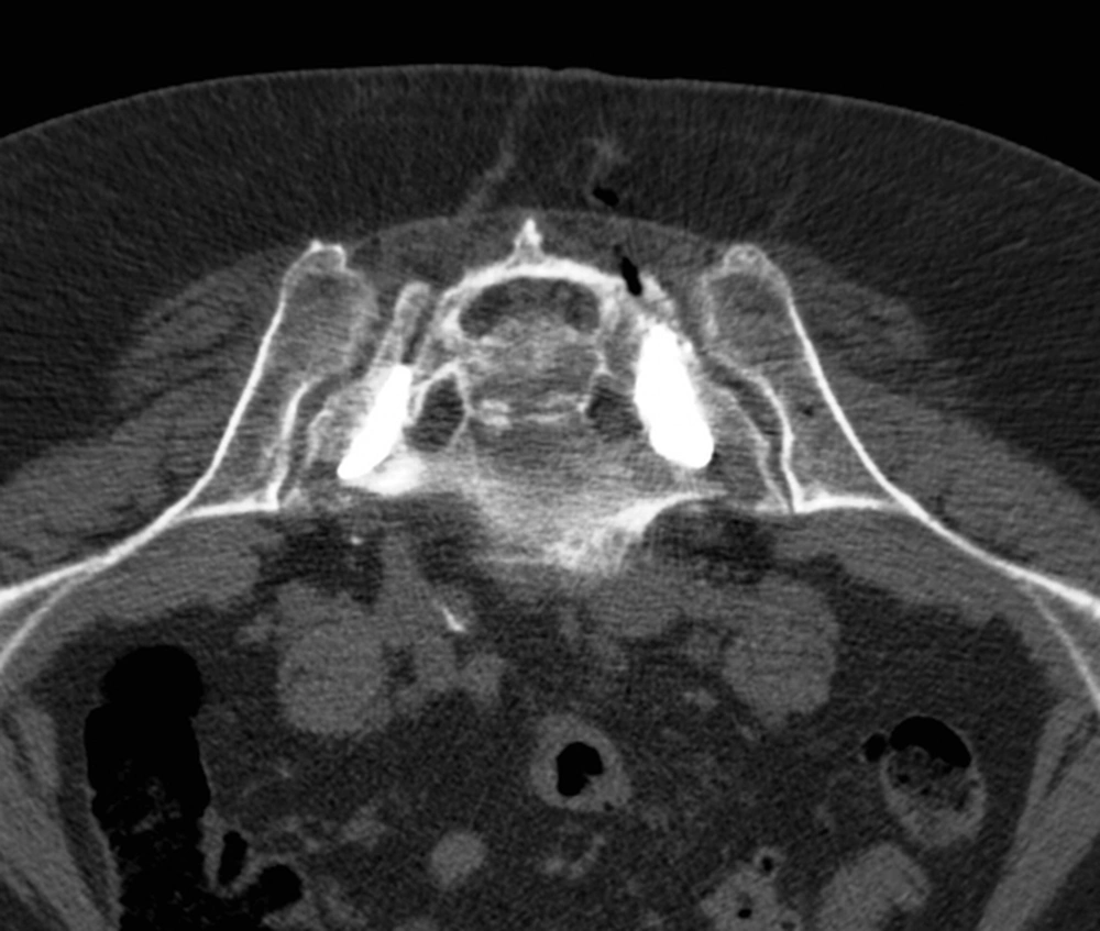 Final examination with thin-sliced CT images to check the correct position and sufficient cement distribution in the mean fracture zones Final examination with thin-sliced CT images to check the correct position and sufficient cement distribution in the mean fracture zones
