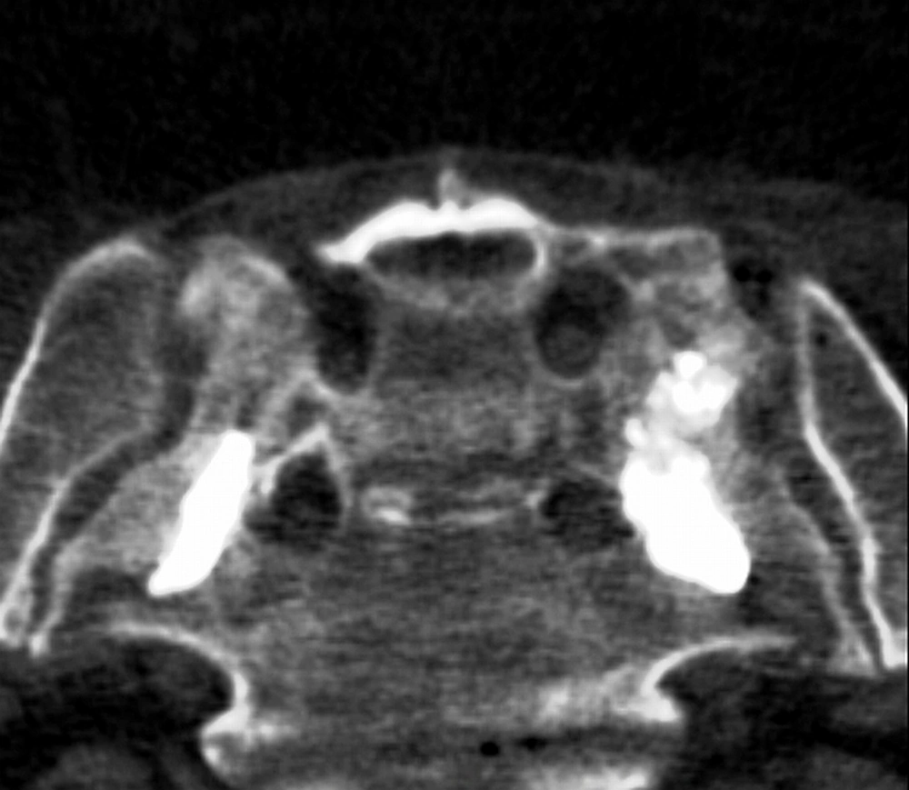 Enlarged and angled post-processed image No cement leakages were detected.