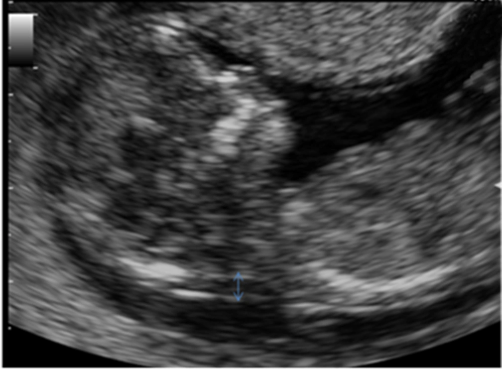 According to the FMF guidelines, NT is measured as the maximal thickness of the sonolucent zone (fluid accumulation) between the inner aspect of the fetal skin and the outer aspect of the soft tissue overlying the cervical spine or the occipital bone. According to the FMF guidelines, NT is measured as the maximal thickness of the sonolucent zone (fluid accumulation) between the inner aspect of the fetal skin and the outer aspect of the soft tissue overlying the cervical spine or the occipital bone.