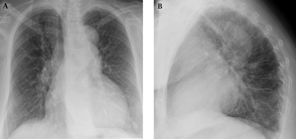 Figure 1. A 77-year-old woman with breast cancer and an abnormal well-defined density in the left paratracheal region. A, Posteroanterior and B, Lateral chest X-rays Figure 1. A 77-year-old woman with breast cancer and an abnormal well-defined density in the left paratracheal region. A, Posteroanterior and B, Lateral chest X-rays