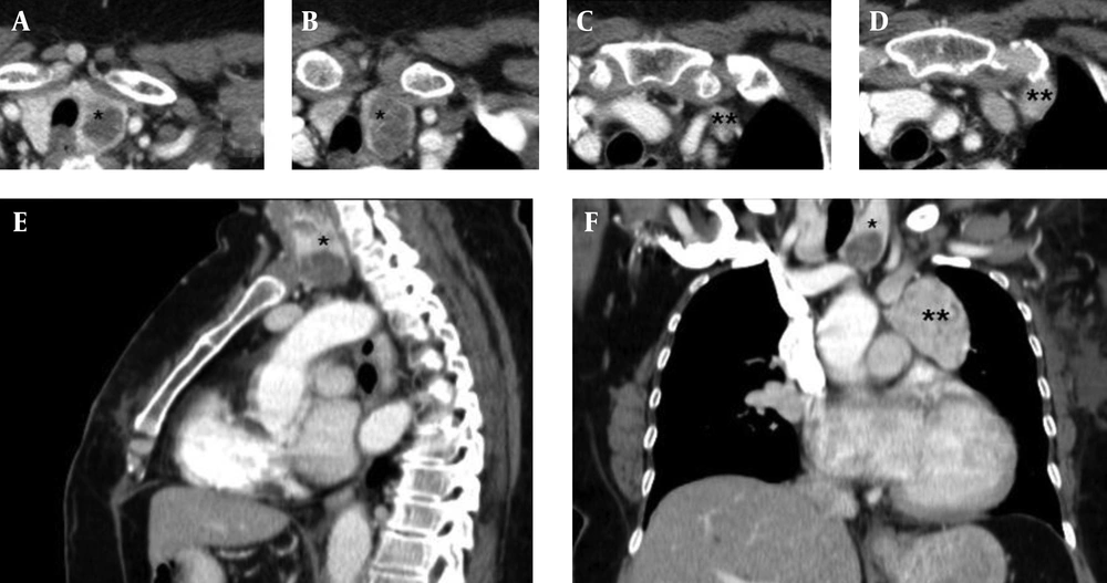 CT scan of the neck and chest, A-D: Axial view, E: Sagittal view, F: Coronal view. CT scan of the neck and chest shows a normally located thyroid gland (*) and the distinct location of the ETT (**). CT scan of the neck and chest, A-D: Axial view, E: Sagittal view, F: Coronal view. CT scan of the neck and chest shows a normally located thyroid gland (*) and the distinct location of the ETT (**).