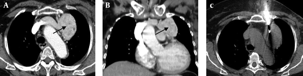 CT scan demonstrates a large anterior mediastinal mass on the left side of the aortic arch (arrow). A, Axial view; B, Coronal view; C, Axial CT images taken during the CT-guided punch biopsy procedure show the path of the semi-automated biopsy system. CT scan demonstrates a large anterior mediastinal mass on the left side of the aortic arch (arrow). A, Axial view; B, Coronal view; C, Axial CT images taken during the CT-guided punch biopsy procedure show the path of the semi-automated biopsy system.