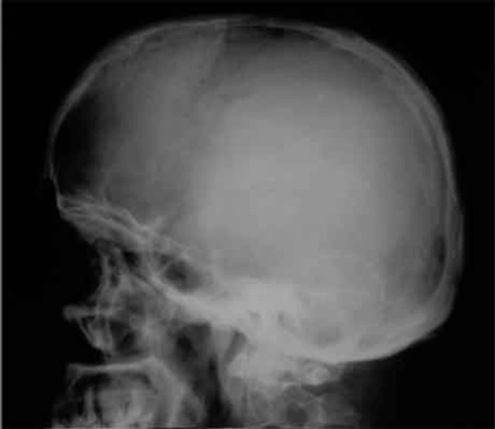 A round fairly well-defined soft tissue density superimposed on the frontal skull without considerable underlying bony destruction. A round fairly well-defined soft tissue density superimposed on the frontal skull without considerable underlying bony destruction.