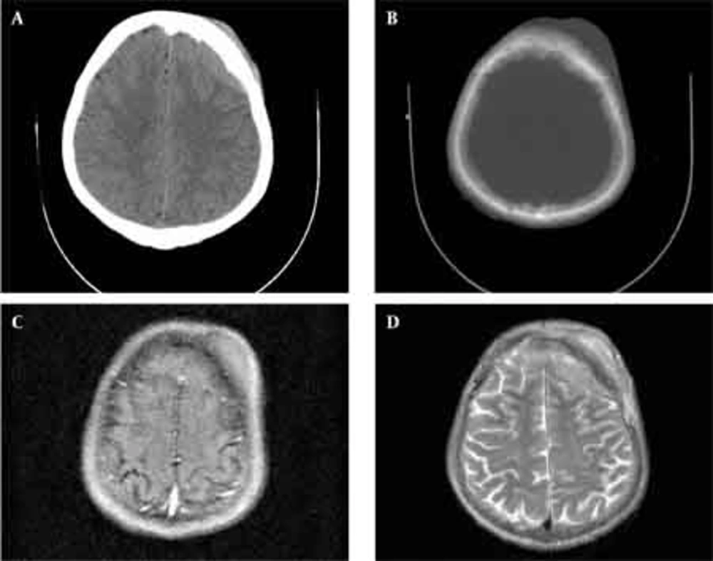 Axial CT scan (A,B), a calvarial lesion with both extra- and intracranial isodense soft tissue components with mild calvarial hyperostotic changes. T1-weighted (C) and T2 weighted (D) MR images show the lesion nearly isointense to gray matter. Axial CT scan (A,B), a calvarial lesion with both extra- and intracranial isodense soft tissue components with mild calvarial hyperostotic changes. T1-weighted (C) and T2 weighted (D) MR images show the lesion nearly isointense to gray matter.