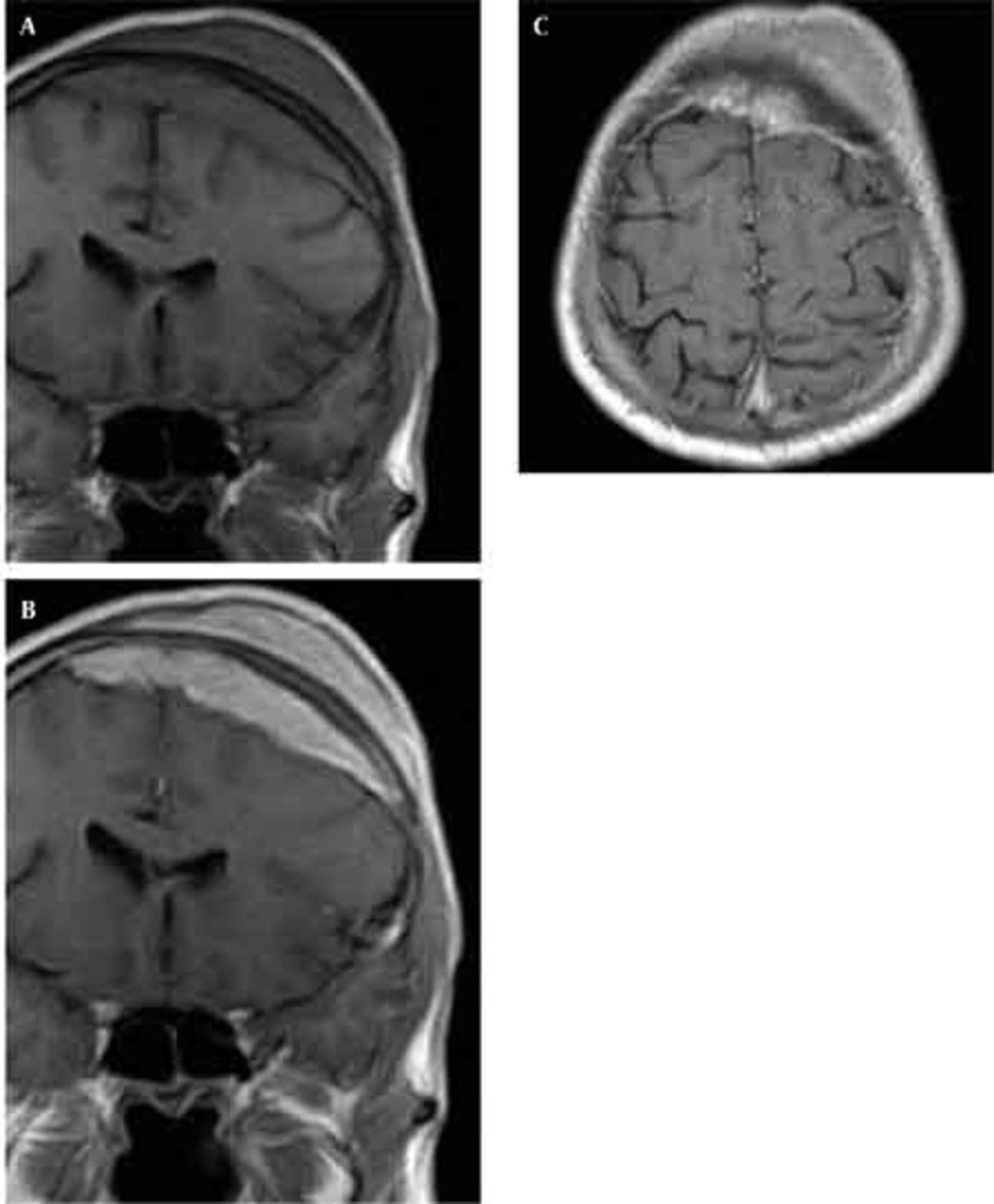 T1-weighted MR image before (A) and after (B,C) contrast medium reveals marked enhancement of the lesion and the dura beneath. Note also the almost normal marrow signal of the intervening skull in the regions without hyperostosis T1-weighted MR image before (A) and after (B,C) contrast medium reveals marked enhancement of the lesion and the dura beneath. Note also the almost normal marrow signal of the intervening skull in the regions without hyperostosis