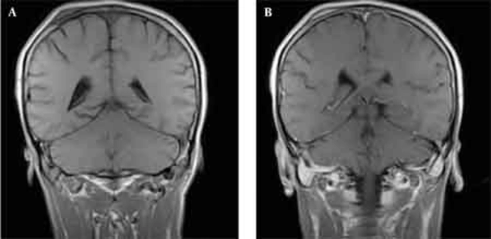 T1-weighted coronal MR image before (A) and after (B) gadolinium. A second small lesion with the same MR signal characteristics extending outward from the right parietal bone