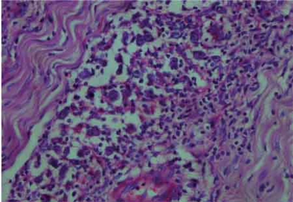Infiltration of meningial tissue by lymphoid cells. Note proliferation of large atypical cells with prominent eosinophilic nucleoli mixed with lymphocytes.