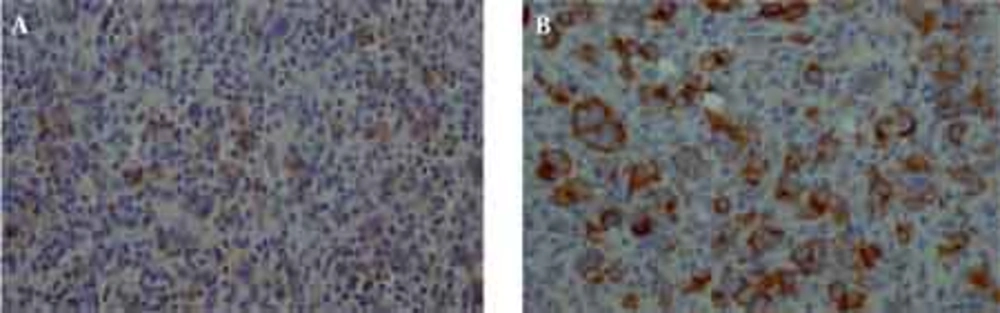 Positive staining for CD20 (A) and CD30 (B) in the large cells could be seen. Positive staining for CD20 (A) and CD30 (B) in the large cells could be seen.
