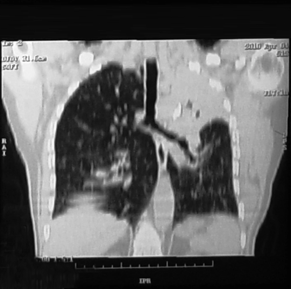 Endobronchial tuberculosis in multiplanar reconstructed thoracic bronchoscopy (stricture and narrowing in the left main bronchus) Endobronchial tuberculosis in multiplanar reconstructed thoracic bronchoscopy (stricture and narrowing in the left main bronchus)