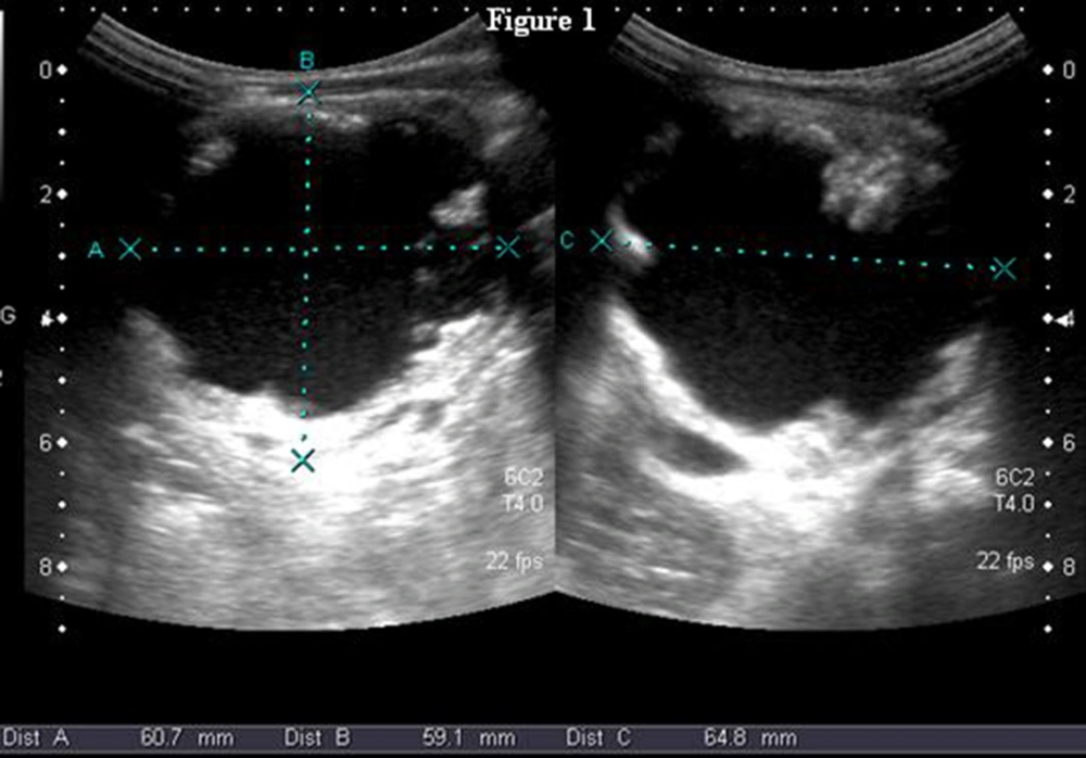 B-Mode US scan of the heterogeneous, cystic-solid mass involving the entire left kidney. The size of the lesion in three planes is 60×59×64 mm. B-Mode US scan of the heterogeneous, cystic-solid mass involving the entire left kidney. The size of the lesion in three planes is 60×59×64 mm.