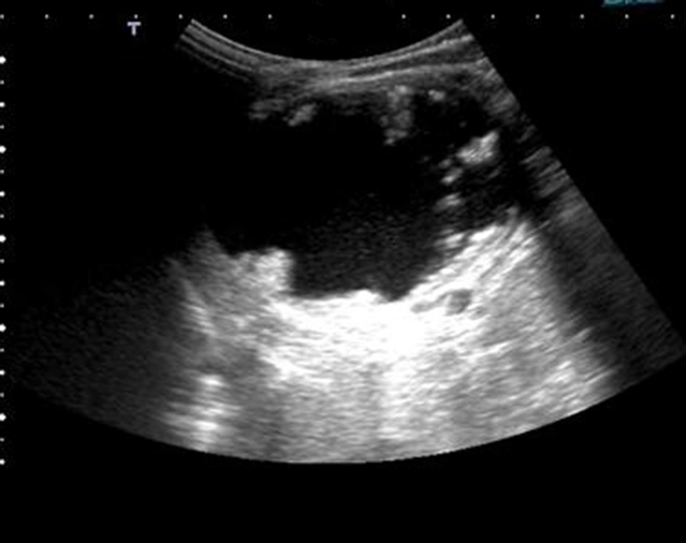 Sonographic posterior acoustic enhancement of the semi-solid cystic mass is clearly seen. Sonographic posterior acoustic enhancement of the semi-solid cystic mass is clearly seen.