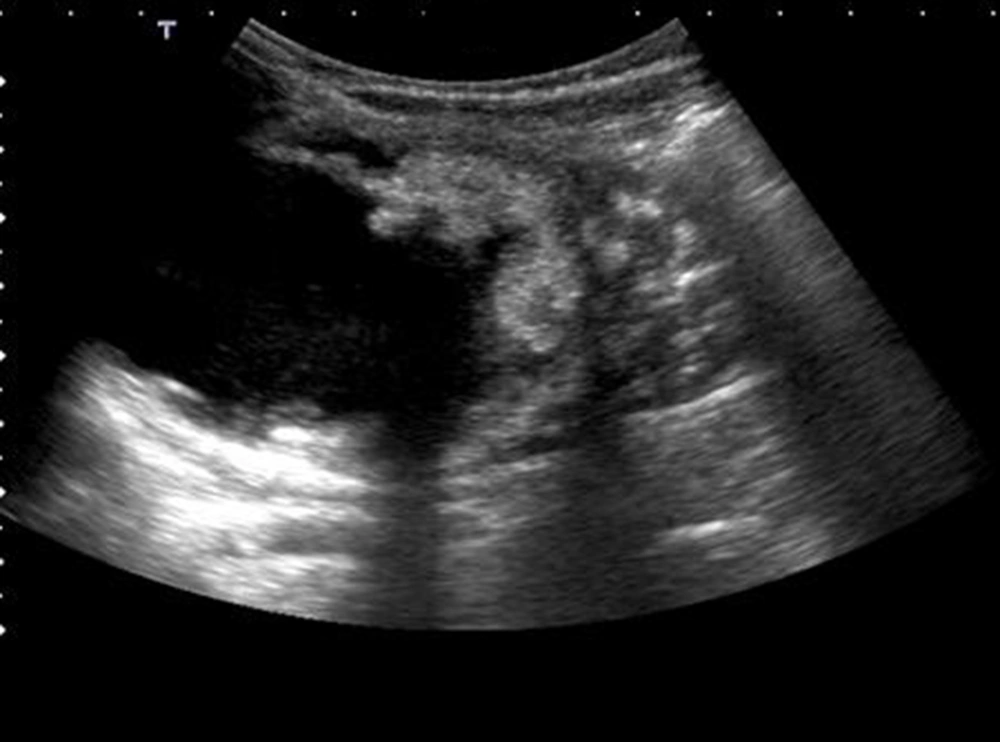 Nodular protrusion of the solid component towards the central region and anechoic-cystic central component is seen. Calcifications are not remarkable in US. Nodular protrusion of the solid component towards the central region and anechoic-cystic central component is seen. Calcifications are not remarkable in US.