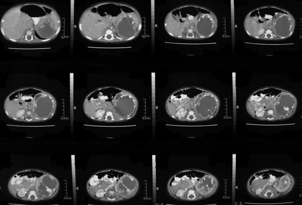 Helical CT examination of heterogeneous, cystic renal mass within the left retroperitoneal site shows peripheral fatty tissue deposits with low attenuation values. Helical CT examination of heterogeneous, cystic renal mass within the left retroperitoneal site shows peripheral fatty tissue deposits with low attenuation values.