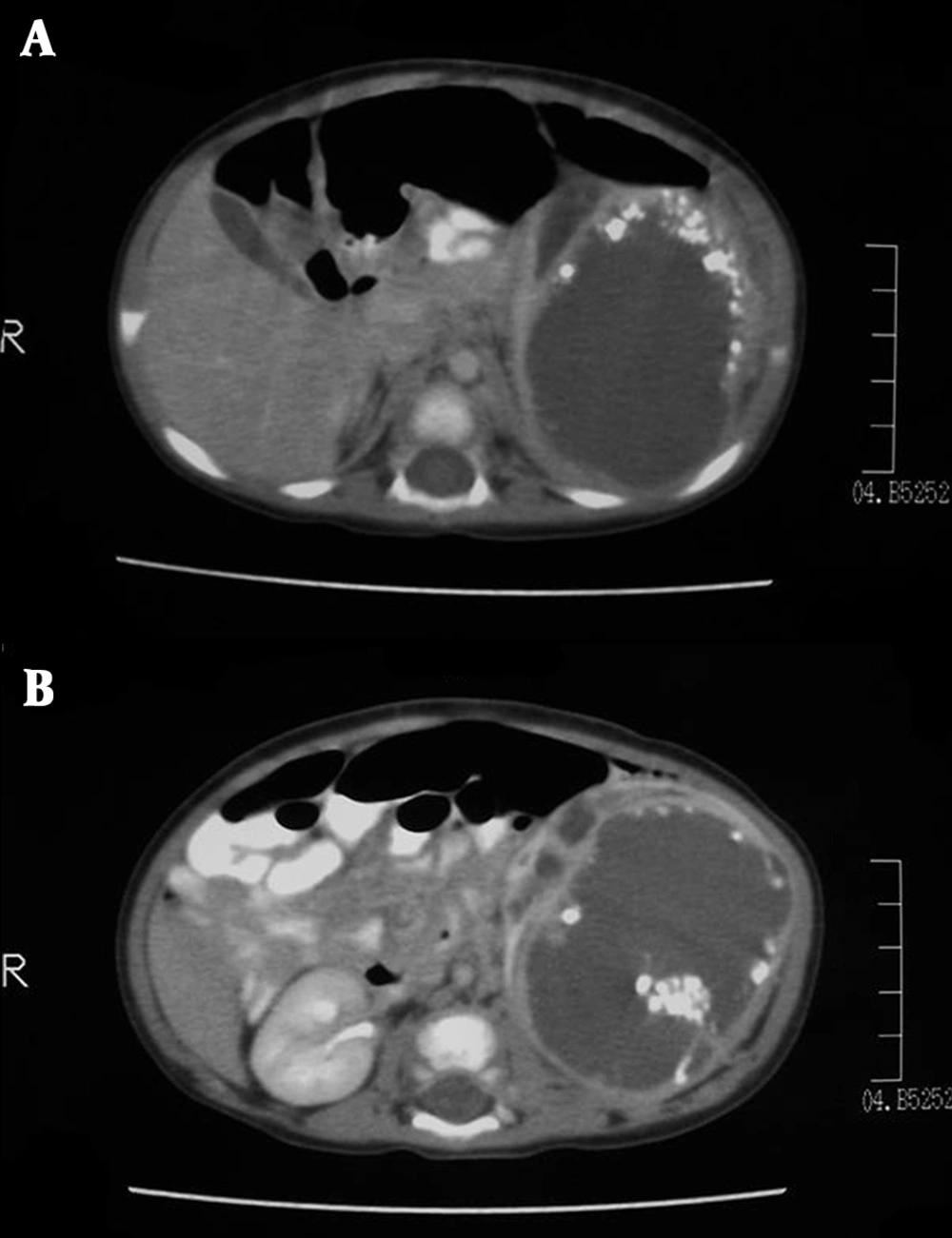 A, Peripheral coarse calcifications on CT. B, Calcifications are clustered in particular regions of the mass. A, Peripheral coarse calcifications on CT. B, Calcifications are clustered in particular regions of the mass.