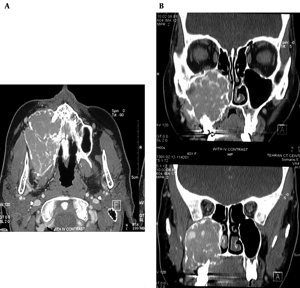 A 35-year-old woman with gradually swelling of the right maxilla. Axial (A) and coronal (B) view of postcontrast facial CT revealed a large lytic expansile multi-septated mass lesion in right maxillary sinus containing septa. Adjacent soft tissue is unremarkable. A 35-year-old woman with gradually swelling of the right maxilla. Axial (A) and coronal (B) view of postcontrast facial CT revealed a large lytic expansile multi-septated mass lesion in right maxillary sinus containing septa. Adjacent soft tissue is unremarkable.