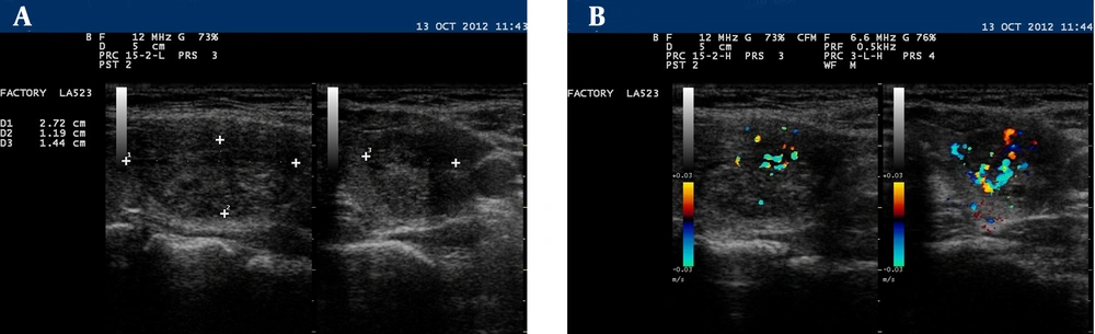 Neck sonography showed a 27 × 14 × 11 mm mixed hypo echoic mass lesion in posterior aspect of right thyroid lobe compatible with vascular parathyroid mass (A,B). Neck sonography showed a 27 × 14 × 11 mm mixed hypo echoic mass lesion in posterior aspect of right thyroid lobe compatible with vascular parathyroid mass (A,B).