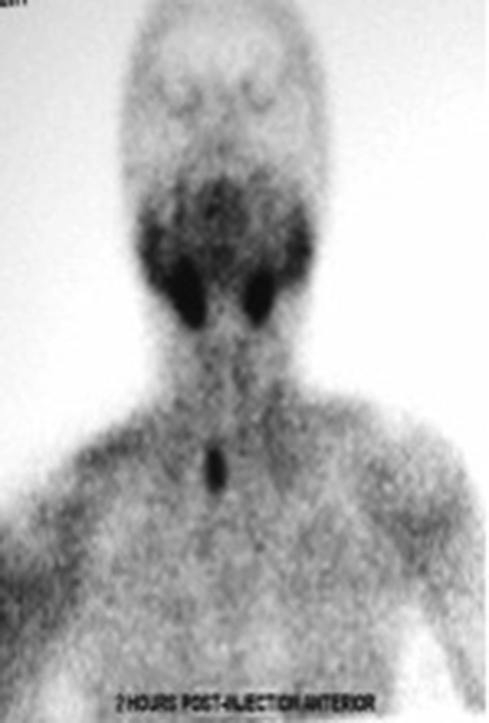 Radioisotope scan (Tc-99 m sestamibi) depicted a right parathyroid hyperplasia. Persistent concentration of radiotracer (after 2 hours injection) in posterior aspect of right thyroid lobe by Tc 99 m sestamibi scan delineated a right parathyroid hyperplasia. Radioisotope scan (Tc-99 m sestamibi) depicted a right parathyroid hyperplasia. Persistent concentration of radiotracer (after 2 hours injection) in posterior aspect of right thyroid lobe by Tc 99 m sestamibi scan delineated a right parathyroid hyperplasia.
