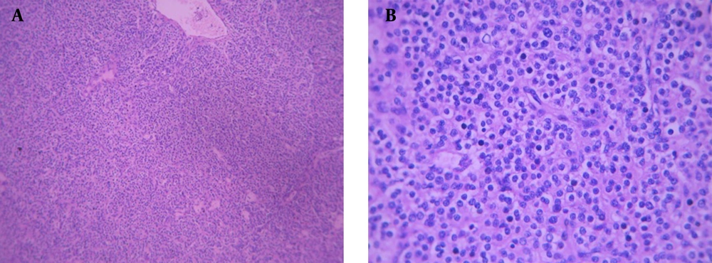In histopathology, the cells had a uniform shape with rounded nucleoli and pale eosinophilic cytoplasm without evidence of fat within the cytoplasm. (A) H and E (× 40), (B) H and E (× 100) In histopathology, the cells had a uniform shape with rounded nucleoli and pale eosinophilic cytoplasm without evidence of fat within the cytoplasm. (A) H and E (× 40), (B) H and E (× 100)