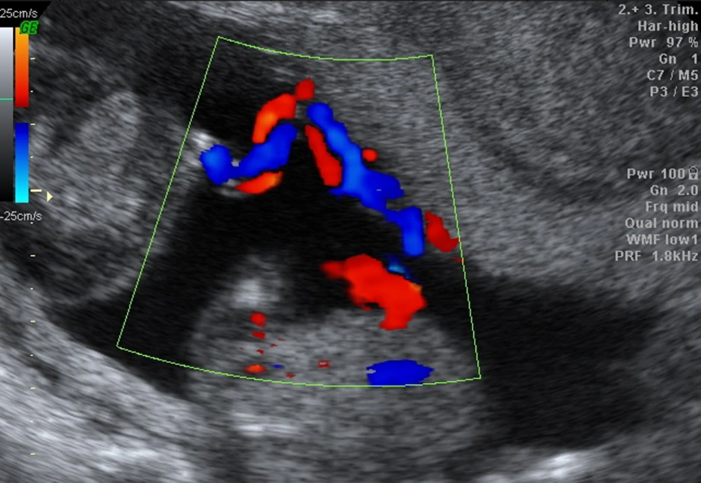Twin fetuses in a 21-year-old pregnant woman with 23 weeks of gestational age and a prediagnosis of fetal anomaly. Ultrasound images in two different twins showing excessive growth of the acardiac twin compared to the pump twin. Twin fetuses in a 21-year-old pregnant woman with 23 weeks of gestational age and a prediagnosis of fetal anomaly. Ultrasound images in two different twins showing excessive growth of the acardiac twin compared to the pump twin.