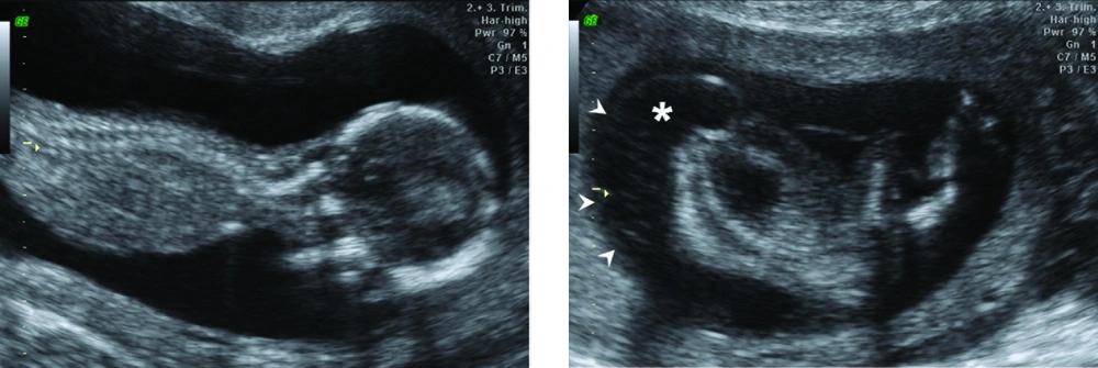 Sonogram of recipient twin demonstrates well-developed lower limbs, partially developed abdomen and thorax, absent head and upper limbs (*), and diffuse soft tissue edema (arrowheads) Sonogram of recipient twin demonstrates well-developed lower limbs, partially developed abdomen and thorax, absent head and upper limbs (*), and diffuse soft tissue edema (arrowheads)