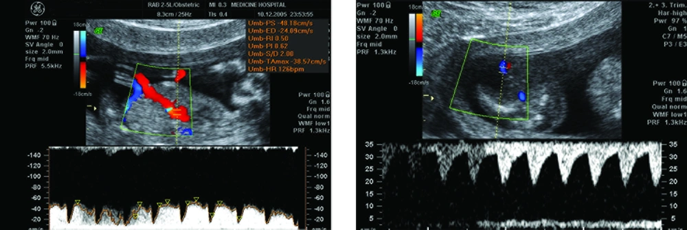 Pulsed Doppler sonographic image of perfused twin demonstrates reversal of flow in the umbilical artery. Umbilical artery S/D ratio is increased in the pump twin and is within normal range in the recipient twin Pulsed Doppler sonographic image of perfused twin demonstrates reversal of flow in the umbilical artery. Umbilical artery S/D ratio is increased in the pump twin and is within normal range in the recipient twin