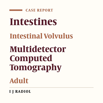 Barber Pole Sign in CT Angiography, Adult Presentation of Midgut Malrotation: A Case Report
