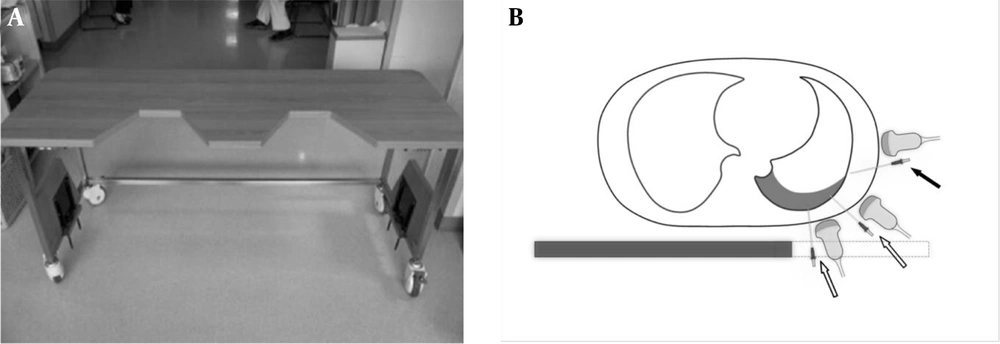 A, A table with gaps at one side of the tabletop was constructed for the cadaver experiment. With the lateral margin of the table carved out, the posterior thorax was exposed for the ultrasound probe and tapping needle to approach it from below. B, Drawing of axial cross section in a typical supine patient with a small-to-moderate effusion. Compared to the conventional method of lateral approach (solid arrow), the effusion can be much more easily visualized and tapped from the posterior and posterolateral aspects of the hemithorax (open arrows) via the carved out (dashed line) portion of the novel supine thoracentesis tabulation. A, A table with gaps at one side of the tabletop was constructed for the cadaver experiment. With the lateral margin of the table carved out, the posterior thorax was exposed for the ultrasound probe and tapping needle to approach it from below. B, Drawing of axial cross section in a typical supine patient with a small-to-moderate effusion. Compared to the conventional method of lateral approach (solid arrow), the effusion can be much more easily visualized and tapped from the posterior and posterolateral aspects of the hemithorax (open arrows) via the carved out (dashed line) portion of the novel supine thoracentesis tabulation.
