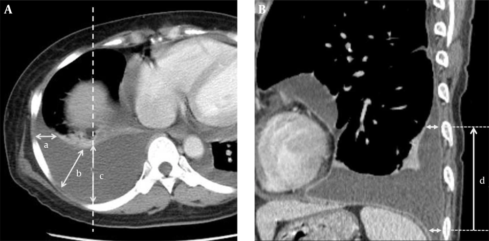 A, The depths of pleural effusion (DPEs) in the lateral (mid-axillary, a), posterolateral (posterior axillary, b) and posterior (posteroanterior direction to the mid-clavicular line (dashed line, c) tapping routes. The maximal DPEs along the routes a, b, and c may or may not be seen on the same axial plane. B, Nearby the costophrenic sulcus, craniocaudal distance of pleural effusion (d) has been measured (DPE > 1 cm). A, The depths of pleural effusion (DPEs) in the lateral (mid-axillary, a), posterolateral (posterior axillary, b) and posterior (posteroanterior direction to the mid-clavicular line (dashed line, c) tapping routes. The maximal DPEs along the routes a, b, and c may or may not be seen on the same axial plane. B, Nearby the costophrenic sulcus, craniocaudal distance of pleural effusion (d) has been measured (DPE > 1 cm).