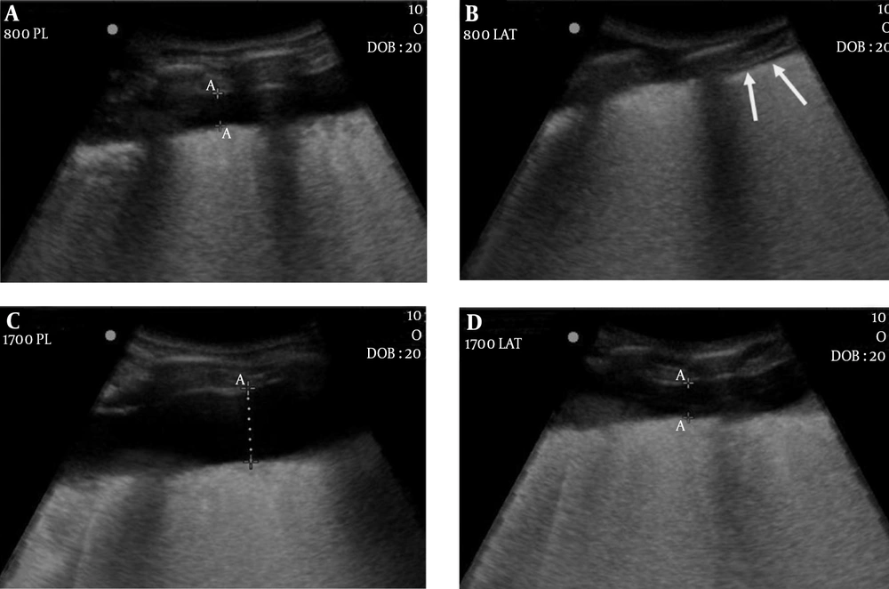 Cadaver 2. A, Ultrasonography after administration of 800 mL of water shows the depth of pleural effusion (DPE) exceeding 1 cm (1.12 cm) in the posterolateral approach; B, However, there is no fluid gap in the lateral approach (arrows); D, After administration of 1700 mL of water, DPE is slightly greater than 1 cm (1.18 cm); C, While that in the posterolateral approach is much greater than 1 cm (2.51 cm). Cadaver 2. A, Ultrasonography after administration of 800 mL of water shows the depth of pleural effusion (DPE) exceeding 1 cm (1.12 cm) in the posterolateral approach; B, However, there is no fluid gap in the lateral approach (arrows); D, After administration of 1700 mL of water, DPE is slightly greater than 1 cm (1.18 cm); C, While that in the posterolateral approach is much greater than 1 cm (2.51 cm).