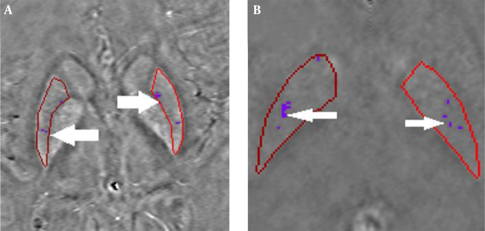 Quantitative susceptibility mapping showing calcium content in a 33-year old female; A, Calcium content in putamen at threshold (-51); B, Calcium content in globus pallidus at threshold (-49) Quantitative susceptibility mapping showing calcium content in a 33-year old female; A, Calcium content in putamen at threshold (-51); B, Calcium content in globus pallidus at threshold (-49)