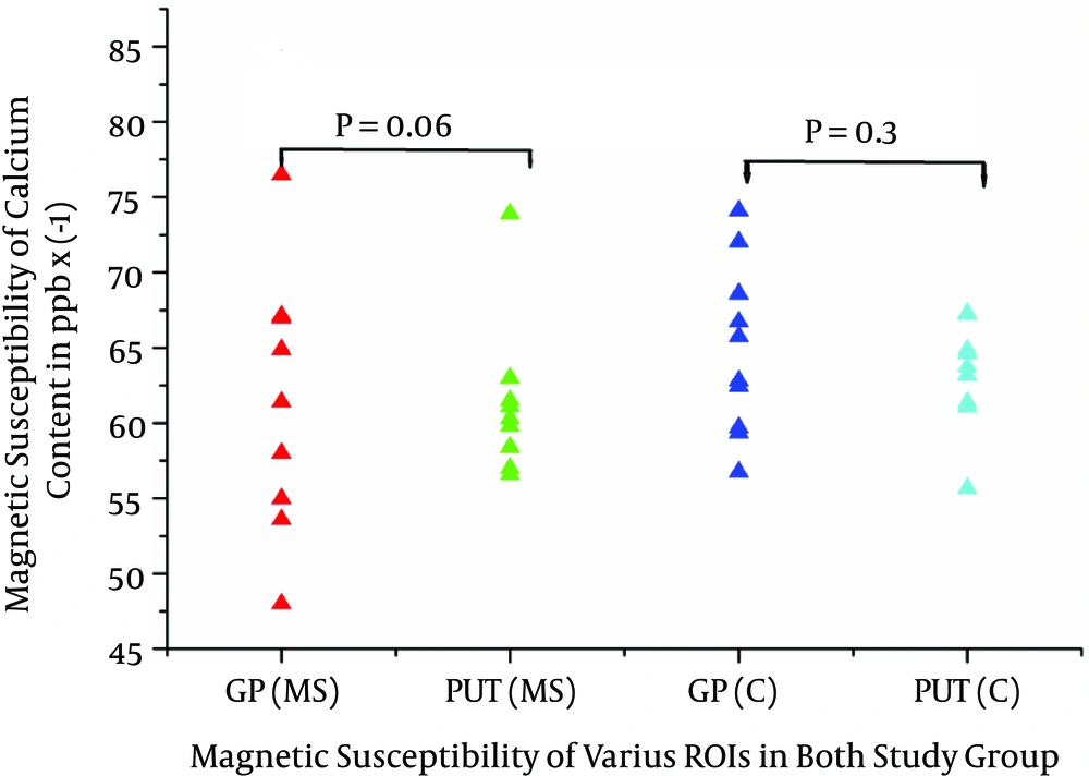 Magnetic susceptibility of various regions of interest (ROIs) in multiple sclerosis (MS) patients versus healthy (H) subjects (GP, globus pallidus; PUT, putamen) Magnetic susceptibility of various regions of interest (ROIs) in multiple sclerosis (MS) patients versus healthy (H) subjects (GP, globus pallidus; PUT, putamen)