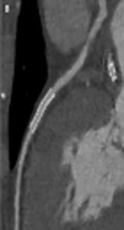 Low-Dose Computerized Tomography (CT) Imaging of Coronary Artery Stents: Potential Value of Sinogram Affirmed Iterative Reconstruction